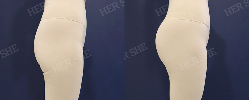 BEFORE & AFTER