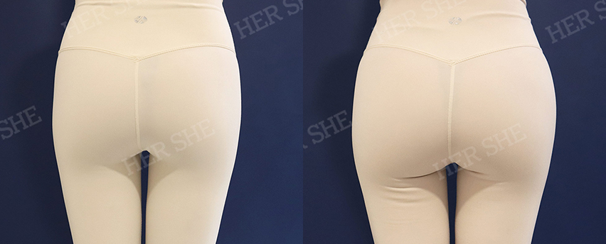 BEFORE & AFTER