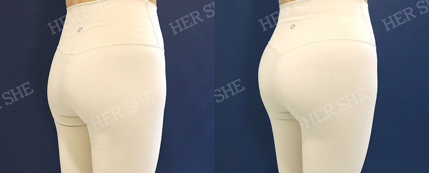 BEFORE & AFTER