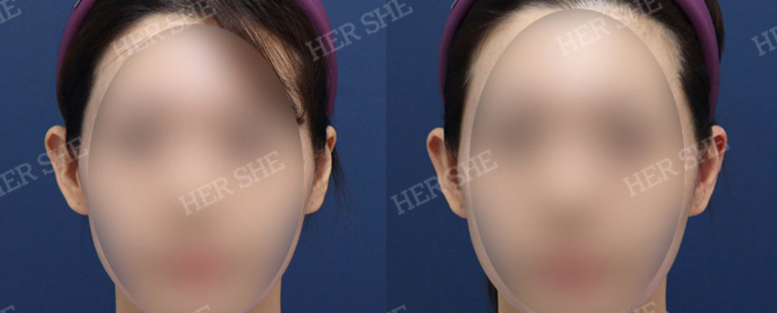BEFORE & AFTER