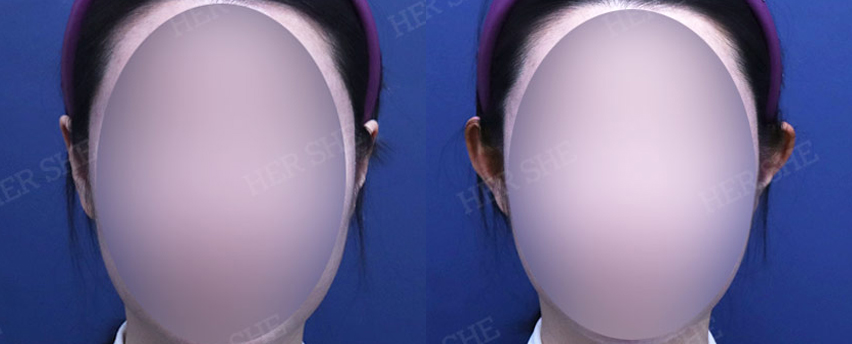 BEFORE & AFTER