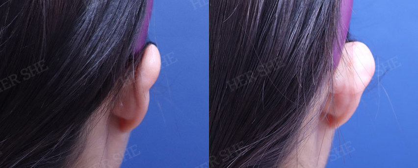 BEFORE & AFTER