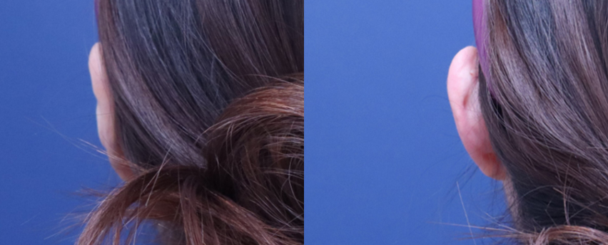 BEFORE & AFTER